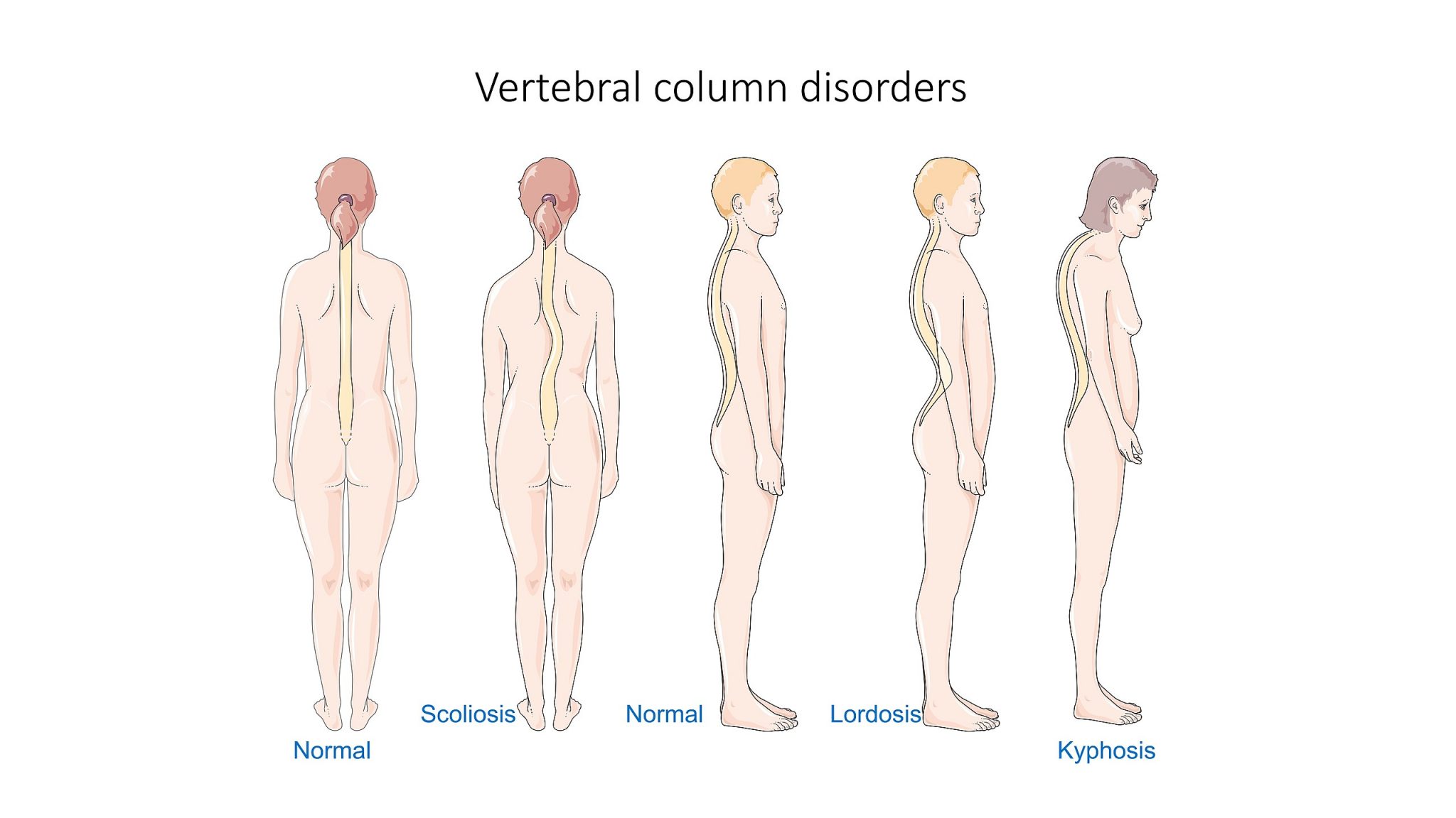 Hyperkyphosis Test for Massage Therapist